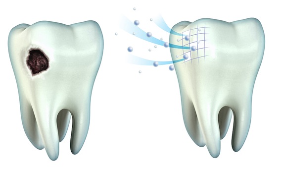 Препарирование зуба: показания, этапы, методы, последствия17