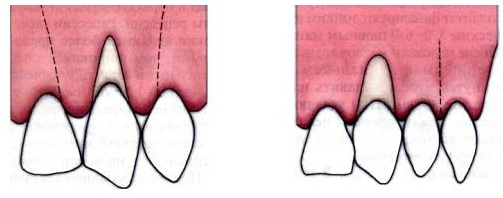 Операции в стоматологии: местная анестезия, гемостаз18