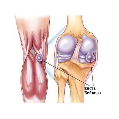 Киста Бейкера коленного сустава: лечение, отзывы, причины, фото