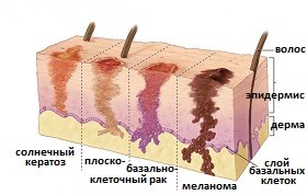 Рак кожи, начальная стадия: фото1