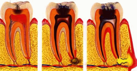 Почему болит зуб под пломбой: причины, диагностика, лечение1
