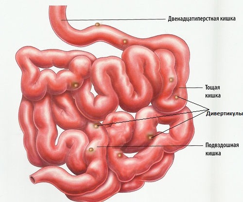 Дивертикулез кишечника: симптомы, осложнения, лечение1