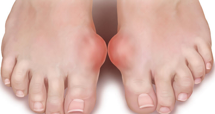 Лечение косточки на пальце ноги: боли, народные средства1