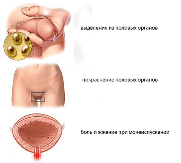 Хламидиоз у женщин: симптомы, лечение1