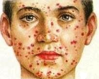 Туберкулез кожи: симптомы, признаки, лечение, фото1