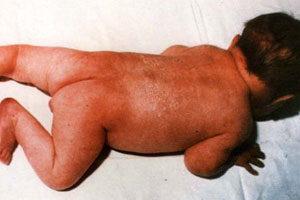 Сифилис раннего детского возраста. Поздний врожденный сифилис1