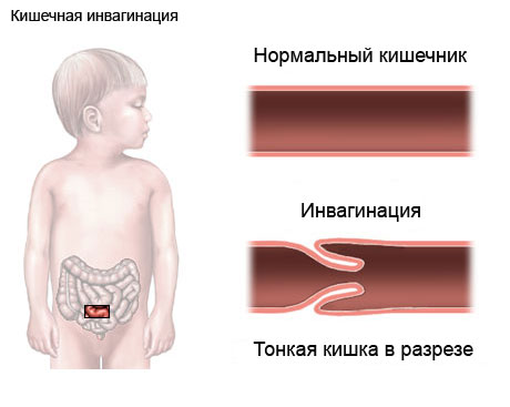 Инвагинация кишечника у детей: причины, симптомы, лечение1