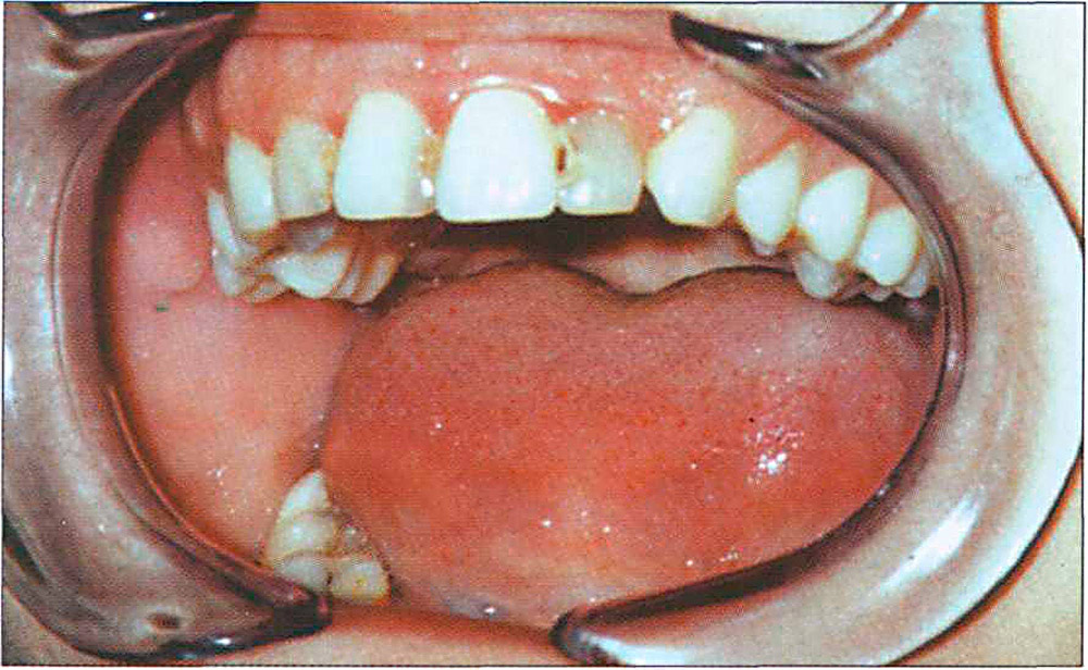 Лечение временных зубов. Некроз пульпы 1