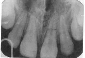 Перелом корня зуба: лечение, методики терапии1