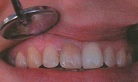 Лечение временных зубов