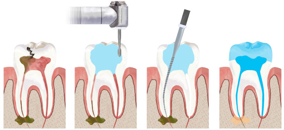 Реплантация зуба. Методики эндодонтического лечения зубов после травмы1