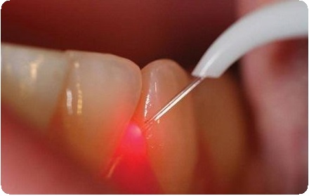 Микрохирургия в стоматологии: показания, этапы, последствия1