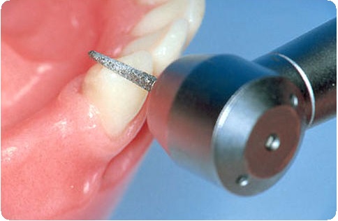 Препарирование зуба: показания, этапы, методы, последствия1