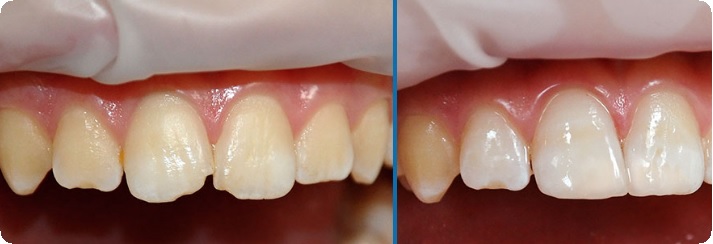 Адгезия в стоматологии: взаимодействие, достоинства, недостатки1