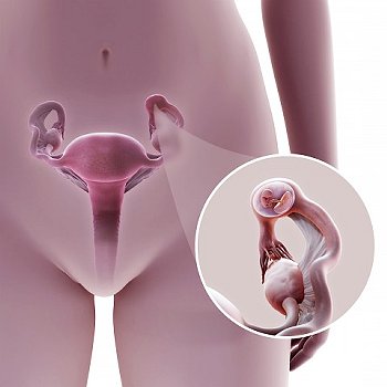 Внематочная беременность: признаки, симптомы, лечение1