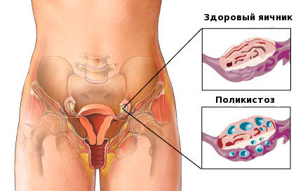 Поликистоз яичников: симптомы. Причины, лечение1