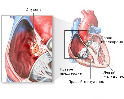 Доброкачественная опухоль в сердце1
