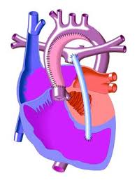 Синдром гипоплазии левых отделов сердца: диагностика, лечение1