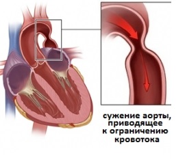 Коарктация аорты: операция, этапы, последствия1