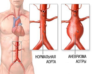 Аневризма аорты брюшной полости: операция, симптомы, лечение1
