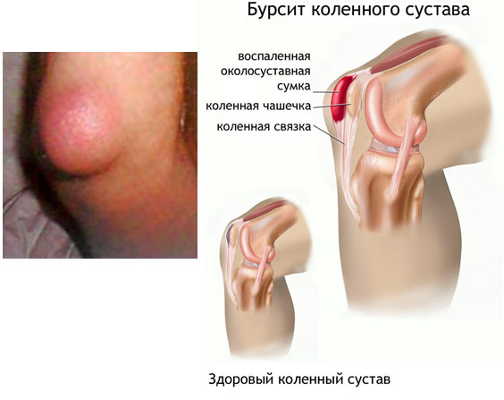 Бурсит коленного сустава: симптомы, лечение в домашних условиях, фото1