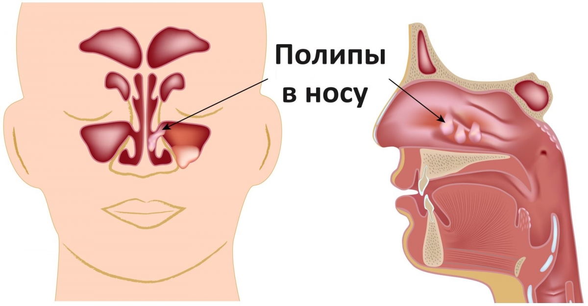 Полипы в носу: удаление, лазерное, эндоскопическое, лечение полипоза1
