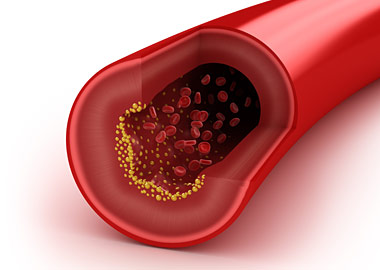 Как снизить холестерин в крови в домашних условиях, народными средствами1
