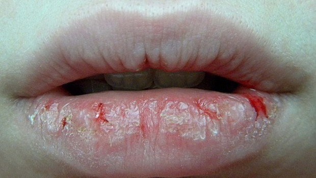 Трещины в уголках губ: причины, лечение, у ребенка, витамины