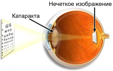Катаракта глаз: симптомы, лечение, причины, операции, профилактика1