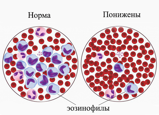 Эозинофилы в крови2