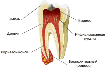Почему болит зуб после пломбирования каналов: способы лечения и устранения боли2