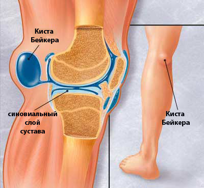 Киста Бейкера коленного сустава: лечение, отзывы, причины, фото2