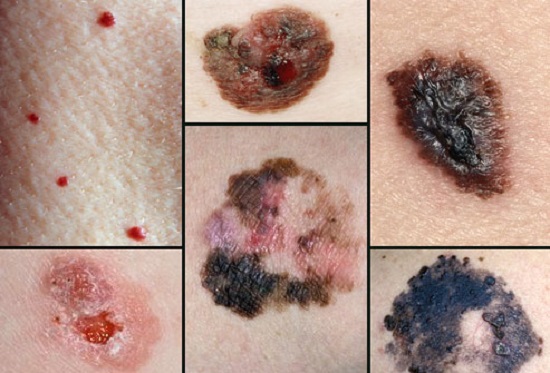 Рак кожи, начальная стадия: фото2