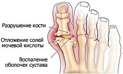 Лечение косточки на пальце ноги: боли, народные средства2
