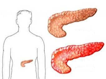 Заболевания поджелудочной железы: симптомы, диагностика2