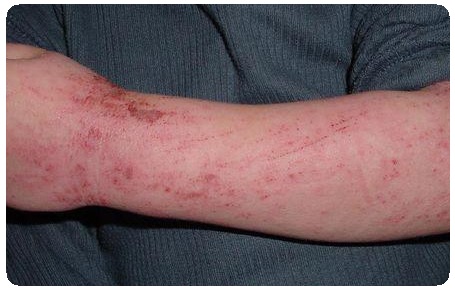 Симптомы заболевания кожи. Общие положения2