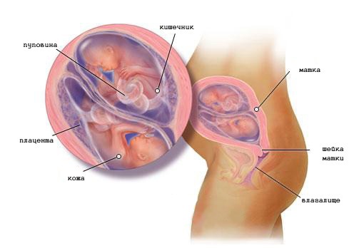 Беременность двойней: диагностика, ведение беременности2