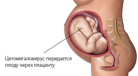 Цитомегаловирус при беременности2
