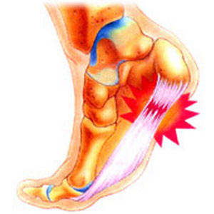 Почему болят пятки ног: причины, симптомы, диагностика, лечение2