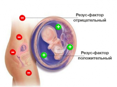 Гемолитическая болезнь новорожденных: симптомы, лечение2