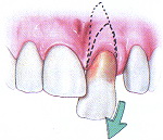 Вывих зуба: полный и неполный. Вывихи молочных зубов у детей