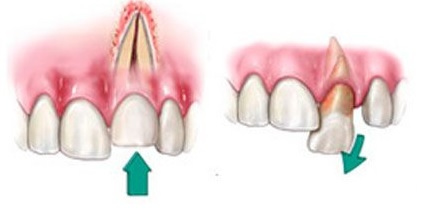 Реплантация зуба. Методики эндодонтического лечения зубов после травмы2