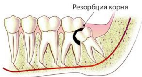 Травматическое повреждение зубов: первая помощь, лечение, последствия2