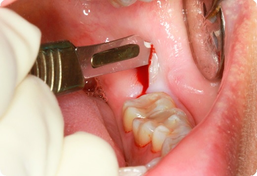Операции в стоматологии: местная анестезия, гемостаз2