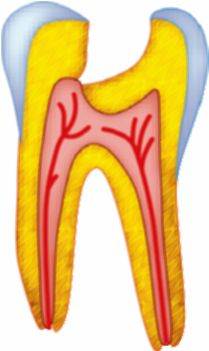 Почему болит зуб после удаления нерва: причины, последствия2