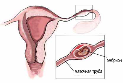 Внематочная беременность: признаки, симптомы, лечение2