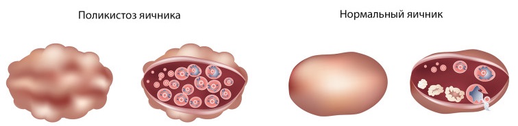 Поликистоз яичников: симптомы. Причины, лечение2