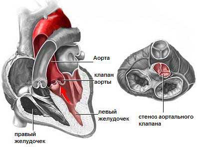 Стеноз аортального клапана: лечение, операция2