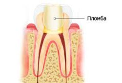Почему болит зуб под пломбой: причины, диагностика, лечение2