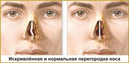 Полипы в носу: удаление, лазерное, эндоскопическое, лечение полипоза2